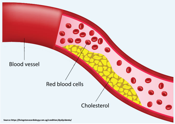 Dyslipidemia Treatment in Ghaziabad | Nivaran Health