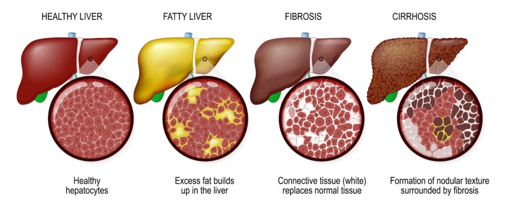 What is Liver Disorder