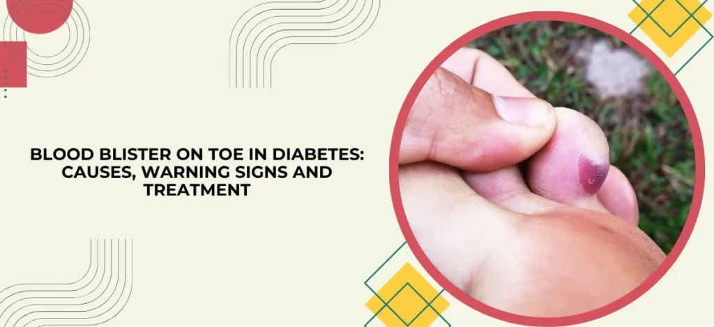 Banner with article title about diabetes-related toe blood blister; right side shows a circular image of a toe with a purple blister in a red-framed circle.